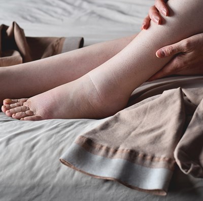 Lipedem: uzroci, simptomi, vježbe i prehrana