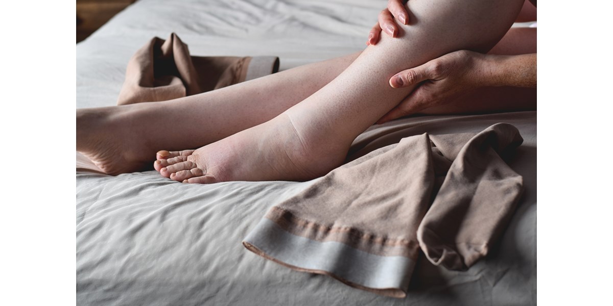 Lipedem: uzroci, simptomi, vježbe i prehrana